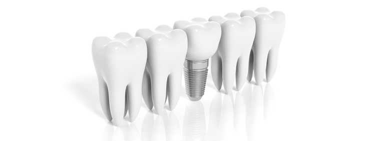 Dental Implants in Port Orange - Dental Restorations