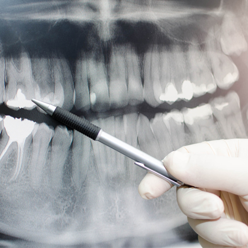 Periodontists - X-Ray Of Teeth