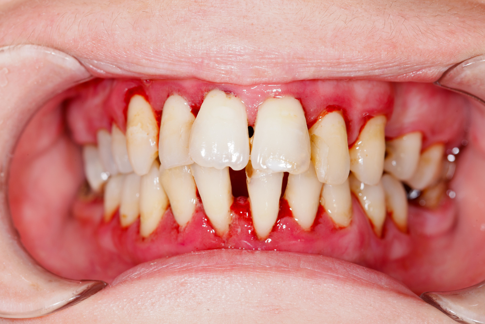Gum Disease - Periodontists