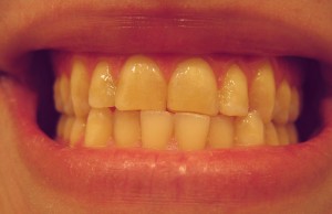 Teeth Whitening In Port Orange